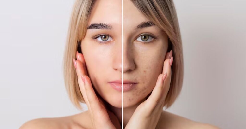 How to treat Melasma at home?